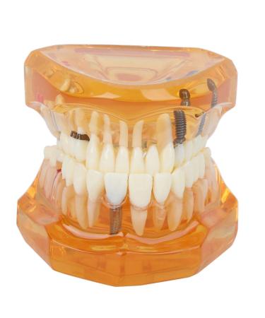 Dpofirs 1PC orange color dental disease removable study teaching dental model tooth model for dental programs dental implant model adult tooth standard demonstration tools