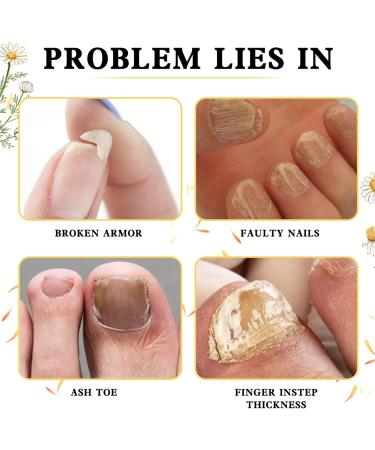 OnyxoGuard Nail Growth and Repair Serum Onyxoguard Serum Onyxoguard Nail Growth Serum Onyxoguard Nail Serum Nail Strengthener for Thin Nails and Growth (2pcs) - Buy Online on GoSupps.com