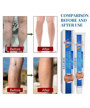 Veinhealth Blue Light Therapy Set for Varicose Veins - Effective Treatment Cream for Legs - Buy Online on GoSupps.com