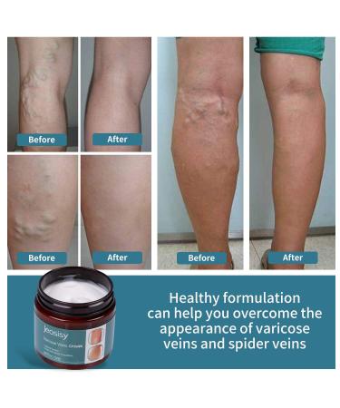 Jeosisy Varicose Veins Cream - Natural Spider Veins Treatment for Legs | 1.76 FL OZ - Buy Online on GoSupps.com