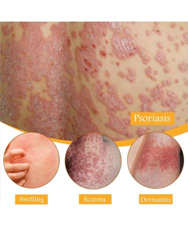 KOAHDE Psoriasis Professional Treatment Cream Bee Venom Psoriasis Treatment Cream Bee Venom Professional Treatment Cream Bee Venom Treatment Cream Bee Venom Topical Cream Bee Psoriasis Repair Cream - Buy Online on GoSupps.com