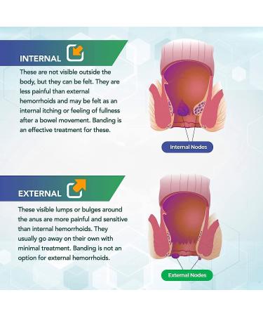 Hemorrhoid & Fissure Cream Hemorrhoid Relief Cream Hemorrhoid Ointment for Swelling Hemorrhoid Treatment Cream for Hemorrhoids Fissures Fast ReliefItching Relief Swelling (1pcs) - Buy Online on GoSupps.com