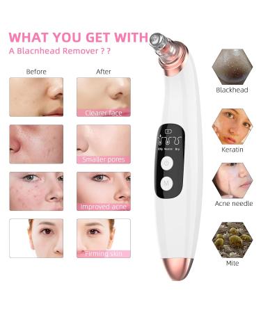 Visual Blackhead Remover Vacuum with Camera | 3 Adjustable Suction Levels | 5 Replacement Probes | USB Rechargeable - Gold - Buy Online on GoSupps.com