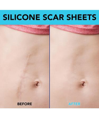 Silicone Scar Sheets 20Pcs - Professional Reusable Silicone Scar Tape for Surgical Scars, C-Section, Burn, Keloid & Acne Removal - Buy Online on GoSupps.com