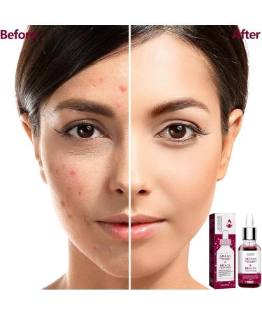 Rosacea Care Rosacea With Natural Moisturizing Fruit Acids Redness Corrector Water Oil Balance Facial Care Improves Skin Relieves Rosacea 30 l - Buy Online on GoSupps.com