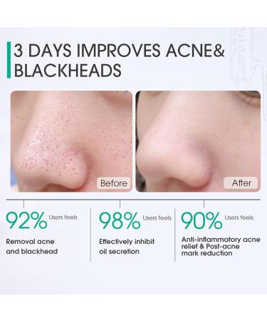 ARCHIDATE 30% Glycolic and 2% Salicylic Acid Pads Glycolic Acid Pad for Face Acne Blackhead Pore Deep Cleaning Oil Control Reduce Wrinkle Fine Line Exfoliation 50 Pads - Buy Online on GoSupps.com