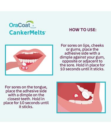 Oracoat CankerMelts Canker Sore Treatment - Stick-On Pain Relief Melts for Fast Acting Relief Inside Mouth with Benzocaine Hyaluronic Acid & Vitamin B12 Pack of 20 - Buy Online on GoSupps.com