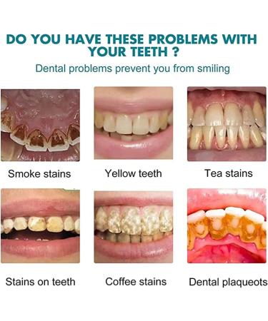Tooth Paint - 15ml Instant Teeth Whitening Gel | 3Pcs Color Correcting Tooth Stain Remover - Buy Online on GoSupps.com
