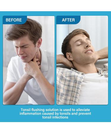 Tonsil Stone Remover Mouthwash | Natural Oral Rinse for Tonsil Relief & Bad Breath | Paraben & Alcohol-Free - Buy Online on GoSupps.com