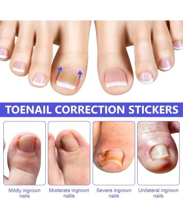 Ingrown Toenail Correction Patch - 100PCS Ingrown Toenail Sticker Breathable Toenail Corrector Patch Professional Ingrown Toenail Tool Painless Pedicure for Ingrown Toenail - Buy Online on GoSupps.com