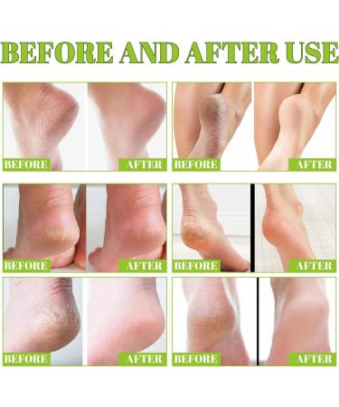 Urea 42% Foot Cream Cracked Heel Repair Cream Foot Cream for Cracked Heels and Dry Skin Urea Foot Cream Foot Moisturiser Athletes Foot Cream Deep Hydrating Heel Cream for Cracked Skin 100g - Buy Online on GoSupps.com