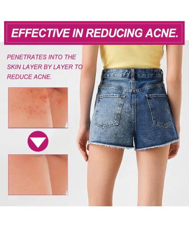  Mikabila (10 F)100ml Ass Acne Cream Glutei Pimple Reduction Glutei Pimple Cream Butt Pimple Clearing Removes Pimple and Redness for Glutei and Coscebutt Cream - Buy Online on GoSupps.com