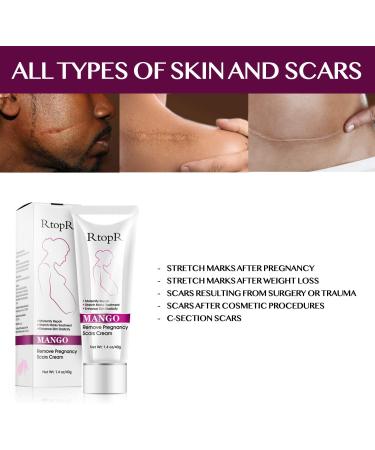 Stretch Mark & Scar Removal Cream (40g) - Effective Skin Repair Solution - Buy Online on GoSupps.com
