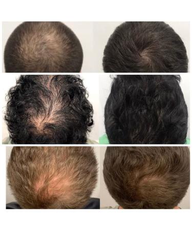 MKKENLEY Ginger Anti Hair Loss Shampoo & Conditioner Set - Hair Growth Treatment for Men & Women - Nourishes Scalp, Promotes Hair Regrowth - 300ml - Buy Online on GoSupps.com