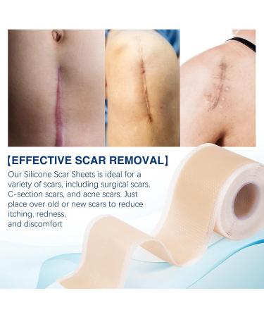 Medical Grade Silicone Scar Sheets (1.6 x130 - 3.3M) for Painless Scar Removal - Surgical Incisions, C-Section, Burn, Keloid, Acne - Silicone Strips Tape Roll - Buy Online on GoSupps.com