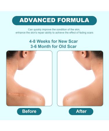BESTEK Scar Cream - Advanced Scar Gel for Surgical Acne Keloids & Stretch Marks - Effective Scar Treatment for Face & Body - 1.76oz/50ml - Buy Online on GoSupps.com
