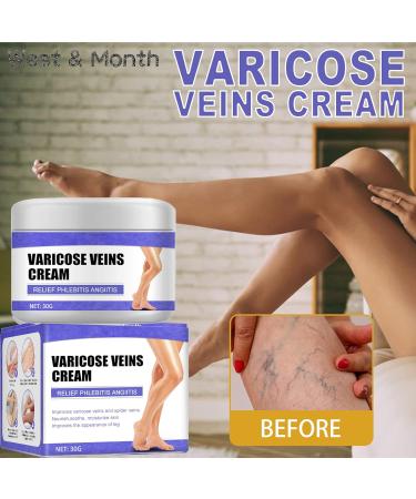 HADAVAKA Vein Care Fading Cream Varicose Vein Cream Leg Swelling Earthworm Leg Care Improve Blood Circulation Relieve Pain of Legs 2 - Buy Online on GoSupps.com