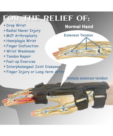 Adjustable Radial Nerve Palsy Splint - Finger Extension Brace for Drop Wrist & Injury Relief | Left & Right Hand Fit - Buy Online on GoSupps.com