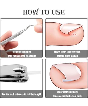 52 Pcs Ingrown Toenail Correction Strips Brace Kit Ingrown Toenail Corrector Toenail Correction Patches Ingrown Toenail Treatment Toenail Straightener Strips with Nail Clipper for Women Men Foot Care - Buy Online on GoSupps.com