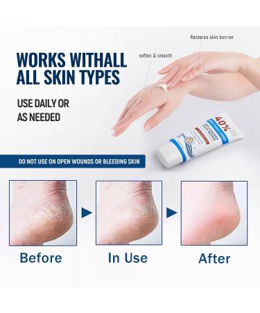 Urea Foot Cream 40 Percent - Cracked Heel Repair Cream For Feet and Hand - Athletes Foot Cream for Very Dry Feet - Foot Moisturiser - Foot Care Cream - Skin Care Cream for Hand Foot and Body 85g - Buy Online on GoSupps.com