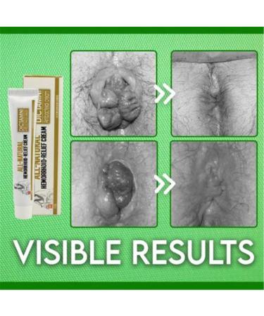 6PCS Chinese Herbal Hemorrhoids Cream | Painless Relief | Maximum Strength Anal Cream - Buy Online on GoSupps.com