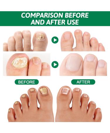 Fungal Nail Treatment Nail Repair Treatment Toenail Fungus Treatment Restores Healthy Nails for Thickening Yellow-Brown Discoloration Repair for Fingernails 30ml transparent - Buy Online on GoSupps.com