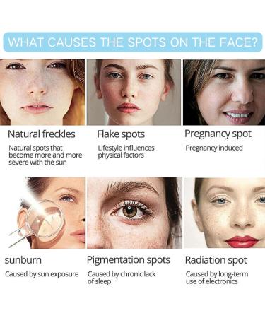 IZBEAUVO Dark Spot Correcting Face Cream Dark Spot Remover For Face and Body Freckle Removal Cream Pigmentation Removal Cream Removal Melasma Cream for Age Spot Sun Spots and - Buy Online on GoSupps.com