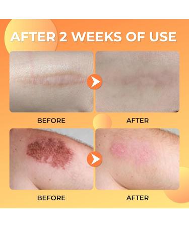 Combo Abera Scar Removal Cream - Advanced Premium Overnight Plumping Treatment for Face and Body with Natural Ingredients - Rapidly Removes Stretch Marks Keloids Burns and More (Buy 4 Get 1) - Buy Online on GoSupps.com