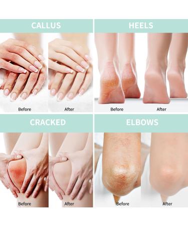 Shop Urea Cream 20% (150g) - Deep Moisture Foot & Hand Cream with Hyaluronic Acid Tea Tree & Aloe Vera - Effective Callus Remover & Skin Softener | International Shipping - Buy Online on GoSupps.com