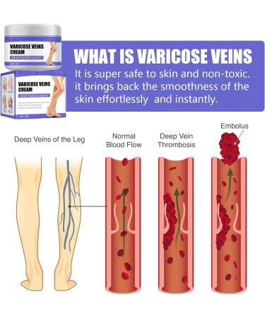HADAVAKA Vein Care Fading Cream Varicose Vein Cream Leg Swelling Earthworm Leg Care Improve Blood Circulation Relieve Pain of Legs 2 - Buy Online on GoSupps.com