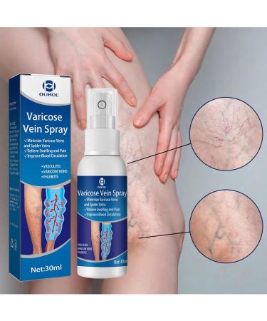 Xiyinli 30 ml Non-Toxic Varicose Vein Spray Relieves Swelling & Pain Improves Circulation - Buy Online on GoSupps.com