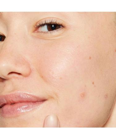 Dermalogica Deep Acne Liquid Patch | Invisible Spot Treatment for Pimples & Blemishes | Sulfur-Based Skin Soothing Solution - 0.5 fl oz - Buy Online on GoSupps.com