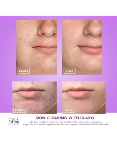 Spa Sciences CLARO LED Acne Treatment Light Therapy | FDA Cleared Professional Home Healing | Blue & Red Light System - Buy Online on GoSupps.com