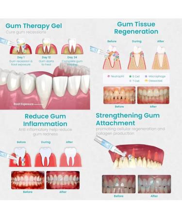 Neslemy Gum Shield Therapy Gel Gum Repair Treatment Gel Dentizen Gum Therapy Gel Teeth Whitening Essence Pen Deeply Cleaning Gums Enhances Overall Gum Health (3 PCS) - Buy Online on GoSupps.com