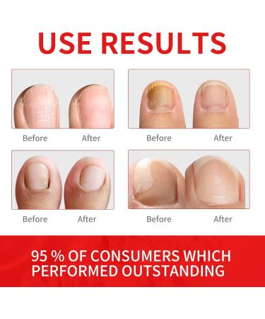 Extra Strength Toenail Fungus Treatment - 30ML Nail Solution with Soft Brush - Transform Your Nails & Boost Confidence - Buy Online on GoSupps.com