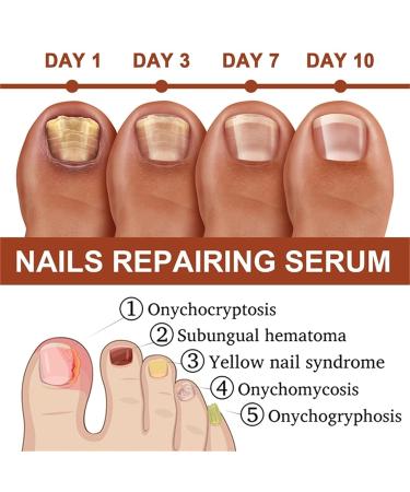 7 Days Nail Growth & Strengthening Serum - Repair Essence for Stronger Nails - 3PC Set - Buy Online on GoSupps.com
