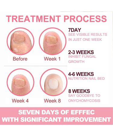Cuticle Cream For Nails | Cuticle Remover Liquid 30ml Natural Softening Effective Absorption Cuticle Softener Cream For Nail Salon Home DIY Povanjer - Buy Online on GoSupps.com