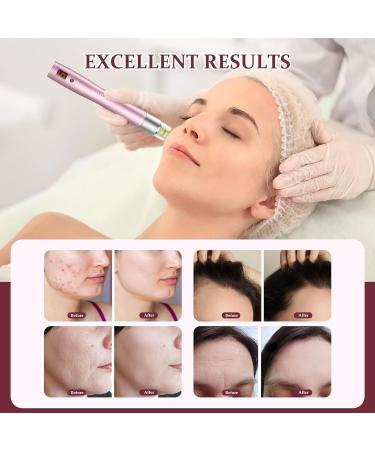 PELCAS Microneedling Pen Automatic Serum Applicator Microneedling 5 Speeds with LCD Screen Type-C Rechargeable Cordless Dermapen for Scars Wrinkles Acne Stretch Marks Skin Rejuvenation - Buy Online on GoSupps.com