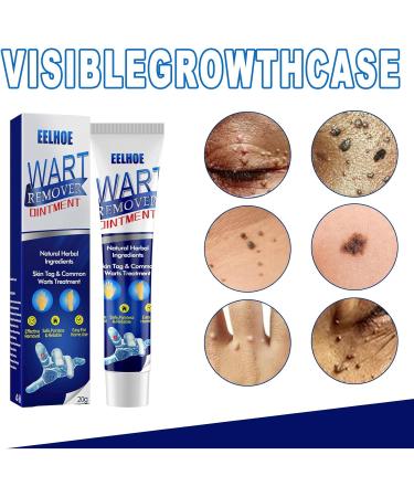 Maximum Strength Fast Acting Wart Cream with Salicylic Acid | Effective Wart Remover for Common Plantar & Genital Warts | International Shipping Available - Buy Online on GoSupps.com