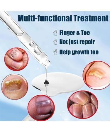 Extra Strength Toe Nail Repair Treatment for Thick, Cracked, Damaged, Discolored Yellow Nails - 30ml - Buy Online on GoSupps.com