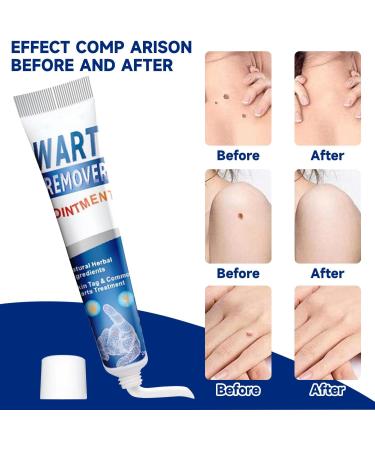  MagiSel Resistant Warts for Hands & Feet Anti-Wart and Anti-Stain Cream Anti-Wart Moisturizing Cream Anti-Corn Foot Descaling Wart Remover for Hands and Feet 20g - Buy Online on GoSupps.com