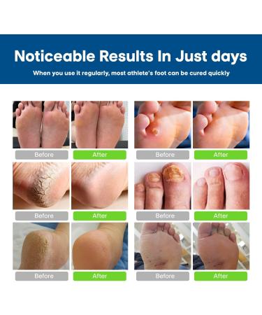 Athletes Foot Treatment Antifungal Cream Anti Fungus Skin Cream Extra Strength Athletes Foot Cream for Men Ringworm Antifungal Cream Fast Relief for Jock Inch & Fungal Infections(1pack) - Buy Online on GoSupps.com