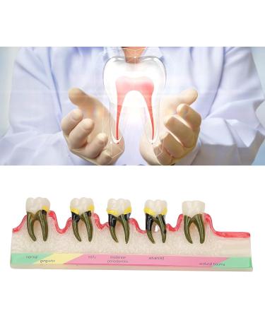 Shop Verdant Touch Tooth Model - Dental Periodontal Disease Study Tool for Schools | International Shipping Available - Buy Online on GoSupps.com