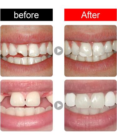 Buy Provisional Dentures & Restorative Dental Adhesive - Temporary Tooth Repair Set for Missing Teeth - Buy Online on GoSupps.com