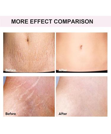 Stretch Marks Cream & Pregnancy Massage Body Butter - 100ml Shea Butter Formula for Reducing & Preventing Stretch Stripes - Buy Online on GoSupps.com