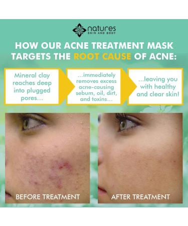 Natural Clear Acne Treatment Mask | Fast Relief for Zits Blemishes & Breakouts | Works Internationally - Buy Online on GoSupps.com