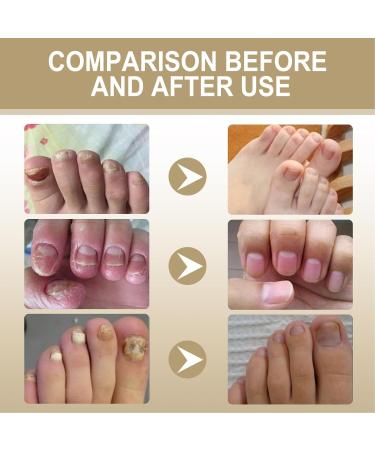 Herbal Nourishing Nail Serum - Instant Shine & Repair | 30ml 2 Pack | Stops Peeling & Moisturizes with Essential Oils - International Shipping Available - Buy Online on GoSupps.com