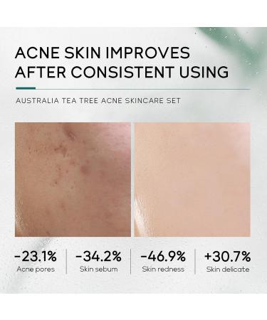 Tea Tree Skincare Set Gifts For Women & Men Acne Treatment Tea Tree Oil Spot And Blackheads Remover Includes-Cleaner Face Serum Acne Gel Toner moisturiser For Acne Removal Oil Control - Buy Online on GoSupps.com