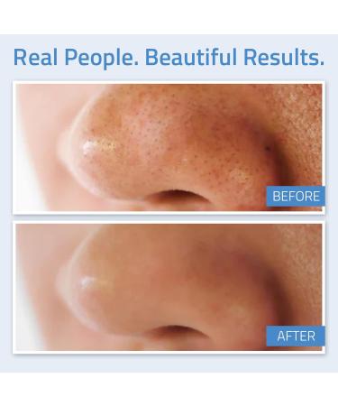 YEOUTH Salicylic Acid Peel 20% - BHA Exfoliator for Clear Skin | Gentle At-Home Exfoliator with Green Tea | 1oz - Buy Online on GoSupps.com