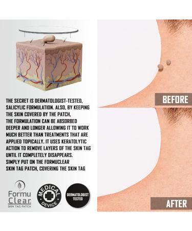 BEST DIRECT FormuClear Original Skin Tag As Seen On TV Box of 30 Patches to Remove Warts Skin Tags Natural and Painless Solution Medical Plaster Rich in Salicylic Acid - Buy Online on GoSupps.com